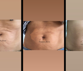 3 Profhilo Body Sessions 1 month apart